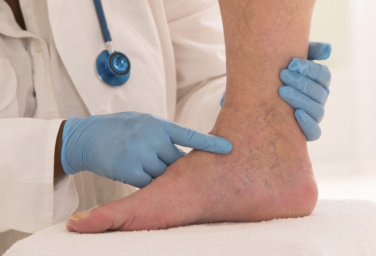 Physical Therapy for Edema Management